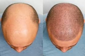 The Ultimate Guide to Hair Transplant in Dubai: A Life-Changing Solution for Hair Loss