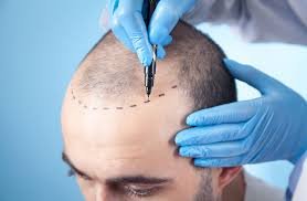 Transform Your Look, Transform Your Life: The Power of Hair Transplant
